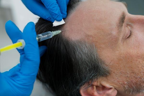 Paciente recibiendo un trasplante de cabello