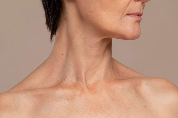 Bótox y ácido hialurónico - Detalle de una mujer con pliegues y arrugas en el cuello como parte del envejecimiento cutáneo antes de un tratamiento en la mejor clínica ácido hialurónico Madrid