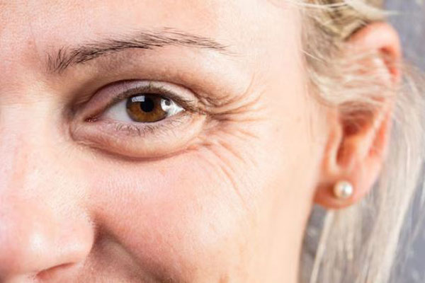 Bótox y ácido hialurónico - Vista ampliada de las patas de gallo en el contorno del ojo de una mujer adulta antes de un tratamiento facial accesible gracias al precio bótox Madrid