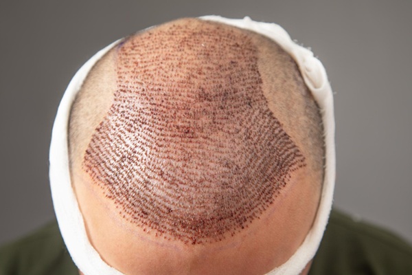 Trasplante capilar Turquía - Hombre con trasplante de cabello en la coronilla realizado en una de las mejores clínicas injerto capilar Turquía