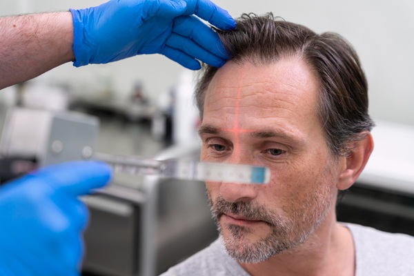 Mejor cirujano capilar España - Médico tricólogo evaluando el cuero cabelludo de un hombre con pérdida de cabello para realizar un implante capilar España