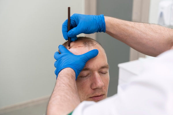 Procedimiento injerto capilar Madrid - Mejor cirujano capilar España realizando el boceto del injerto capilar Madrid a un hombre con alopecia en las entradas