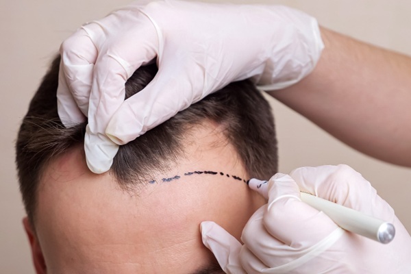 Procedimiento injerto capilar Madrid - Tricólogo realizando el boceto del trasplante capilar Madrid a un hombre con pérdida de cabello en una de las mejores clínicas injerto capilar Madrid