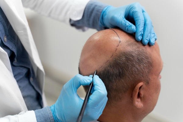 Procedimiento injerto capilar Madrid - Médico capilar realizando el boceto del injerto capilar Madrid a un hombre con alopecia avanzada en la mejor clínica injerto capilar Madrid