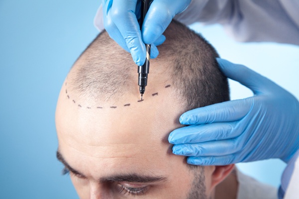 Procedimiento injerto capilar Madrid - Mejor cirujano capilar España realizando el boceto del trasplante capilar Madrid a un hombre con alopecia para determinar el precio injerto capilar