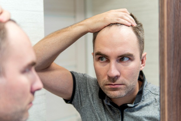 Soluciones para la alopecia - Hombre observando frente al espejo el avance de la calvicie por no aplicarse tratamientos en las mejores clínicas injerto capilar Madrid