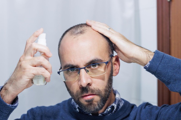 Soluciones para la alopecia - Hombre aplicándose un tratamiento para la calvicie con minoxidil para estimular el crecimiento del cabello