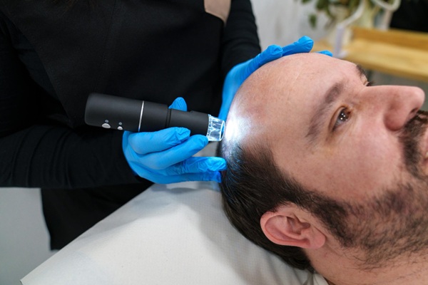 Técnicas de injerto capilar Madrid - Médico capilar realizando un injerto capilar Madrid a un hombre con alopecia avanzada