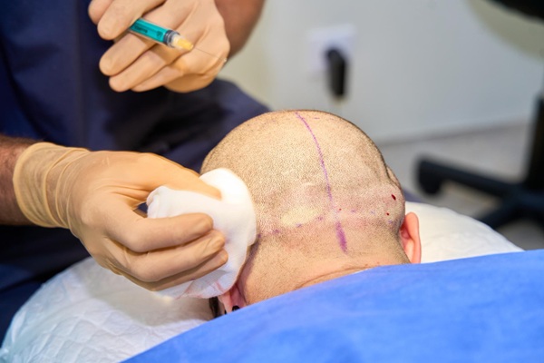 Técnicas de injerto capilar Madrid - Cirujano capilar realizando la extracción de unidades foliculares para un trasplante de cabello en la mejor clínica injerto capilar Madrid